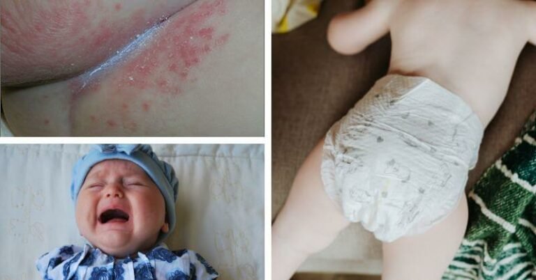 What Is Diaper Rash And How To Get Rid Of It?