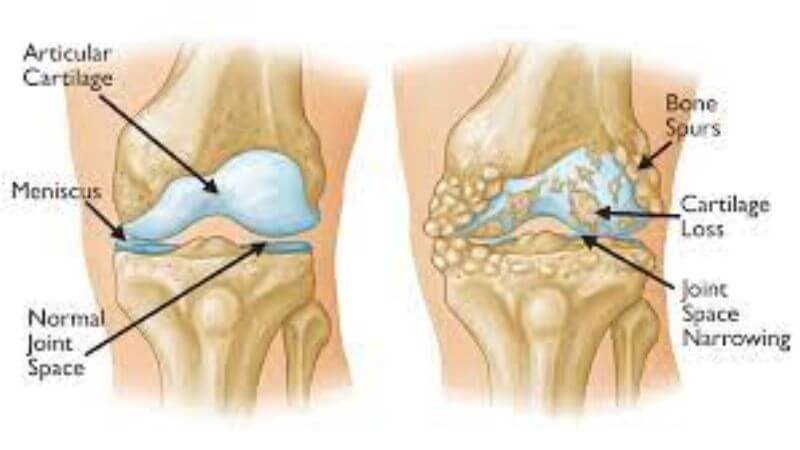 what is Osteoarthritis