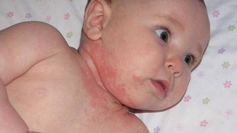 baby neck rash
