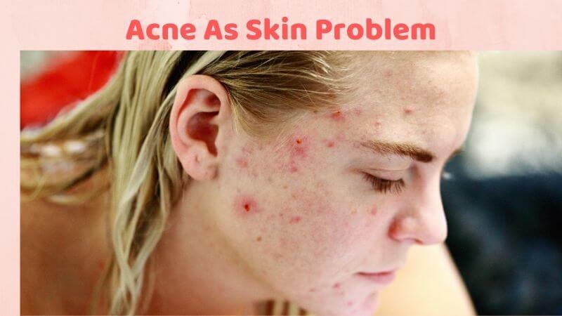 Acne As Skin Problem