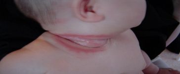 Baby Neck Yeast Infection