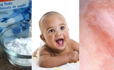 Baking Soda Bath For Diaper Rash