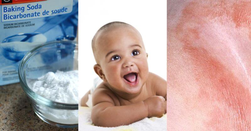 Baking Soda Bath For Diaper Rash