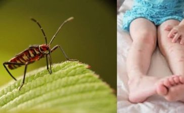 Bed Bug Bites On Baby