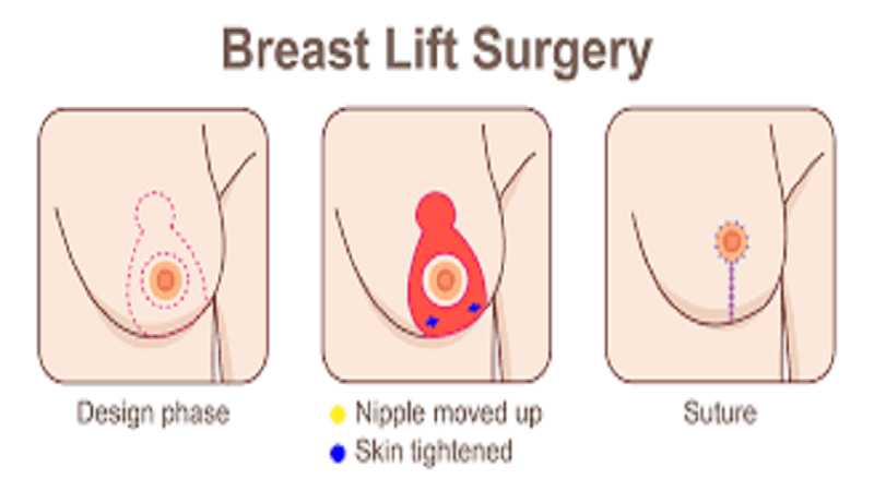 Breast Lift surgery