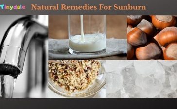 Natural Remedies for Sunburn