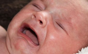 Newborn Lip Blister