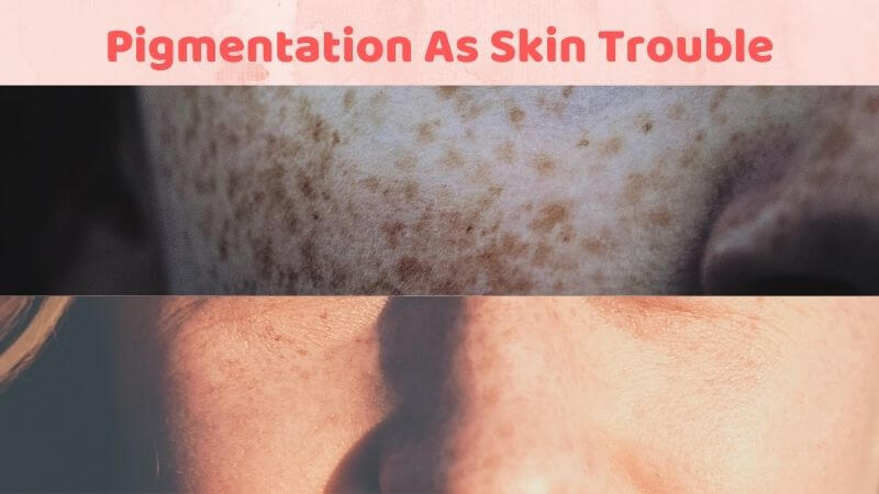 Pigmentation As skin problems