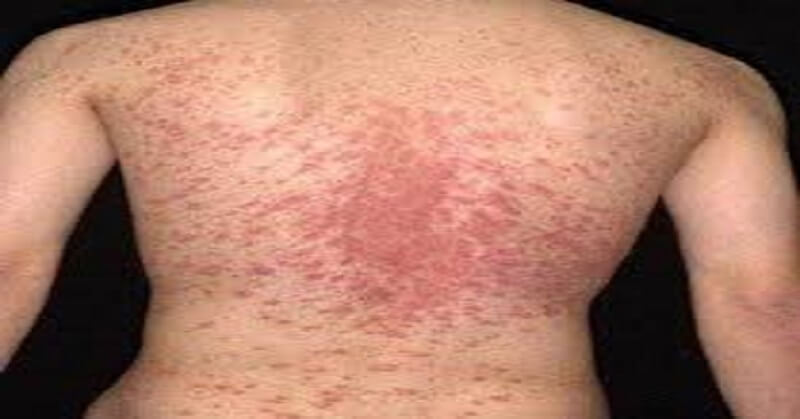 Pityriasis Rosea foods to avoid