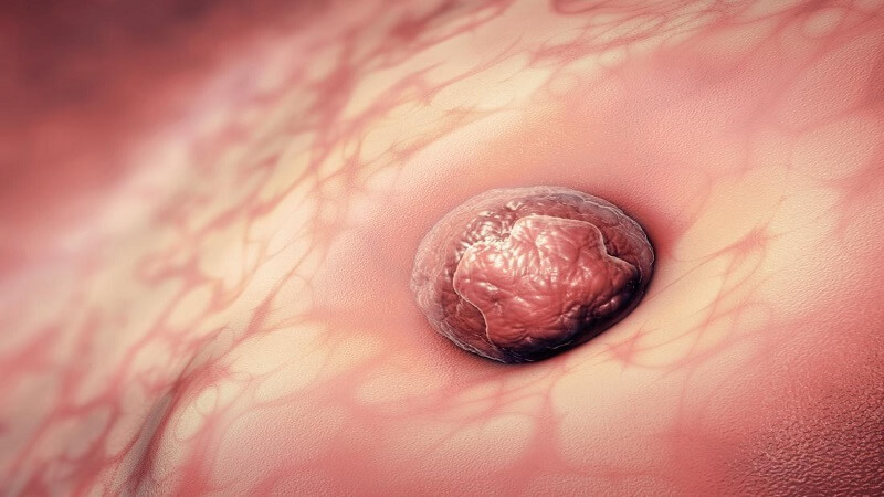 implantation phase - tinydale