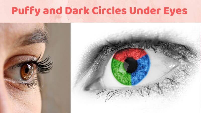 Puffy and Dark Circles Under Eyes