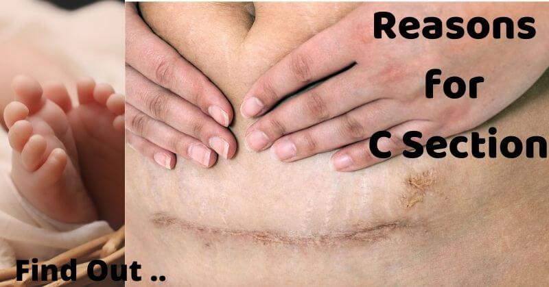 Reasons for c section