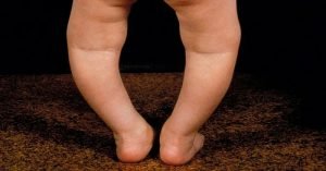 Rickets in children - Symptoms and Treatments