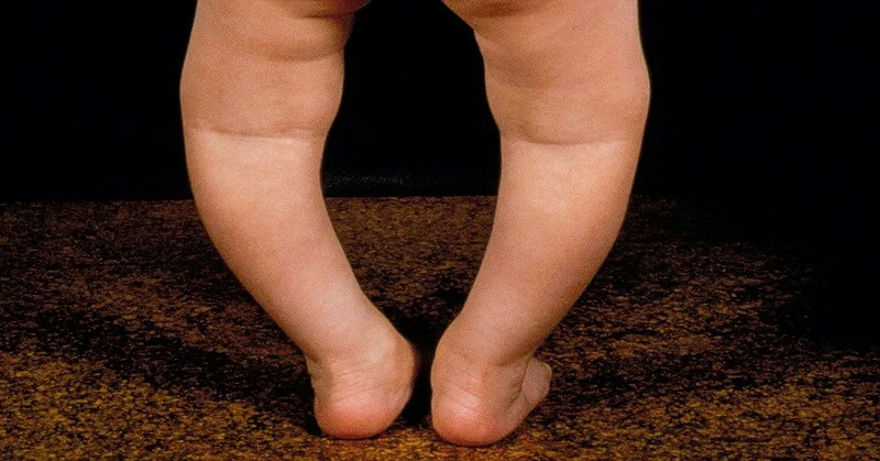 Rickets in children