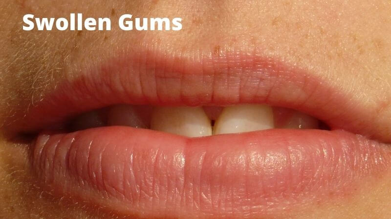 Swollen gums in second trimester