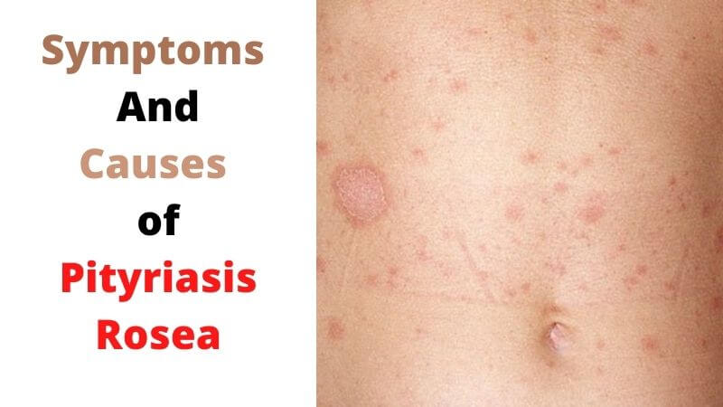 Symptoms And Causes of Pityriasis Rosea