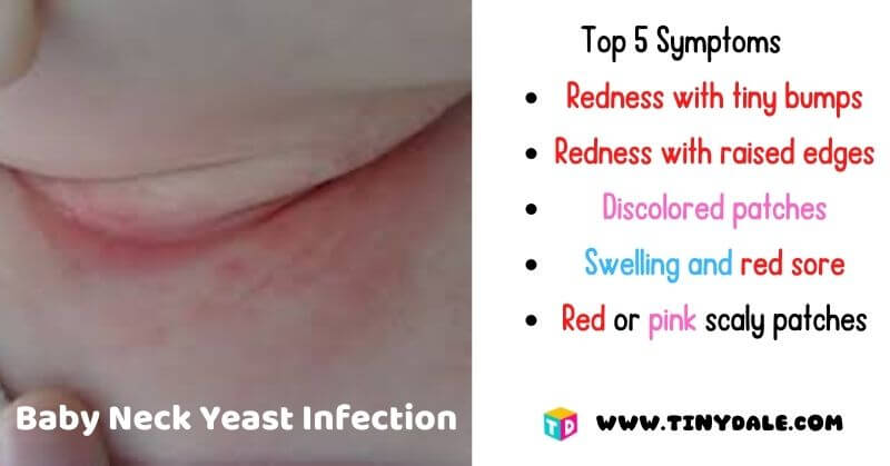 Top 5 Symptoms Baby Neck Yeast Infection