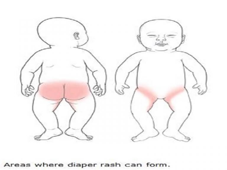 What Is Diaper Rash And How To Get Rid Of It?