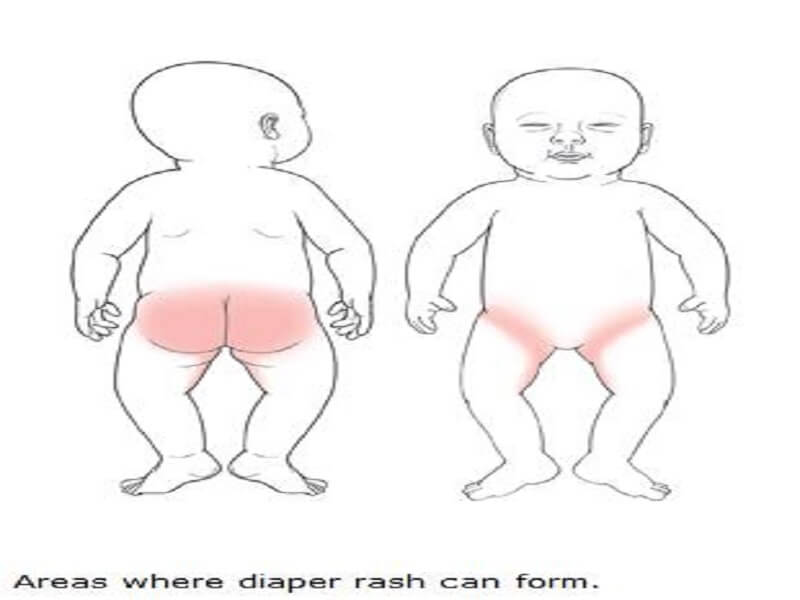 areas of rash