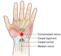 carpal tunnel syndrome