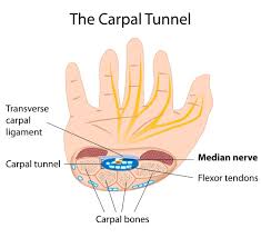 carpal tunnel