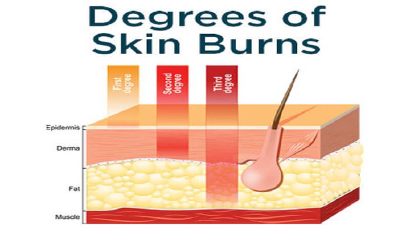 Degrees of skin burns