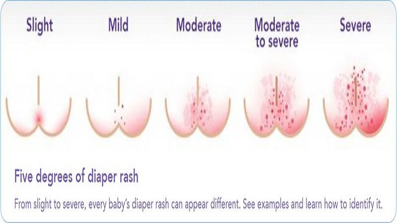 degree of diaper rash