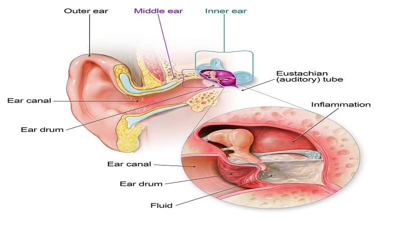 ear-infection