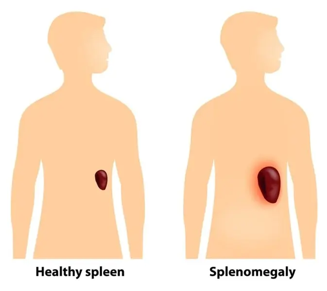 enlarged spleen
