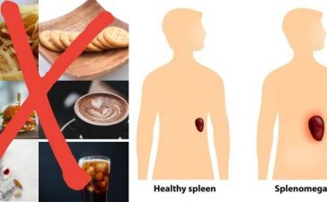 foods to avoid with enlarged spleen