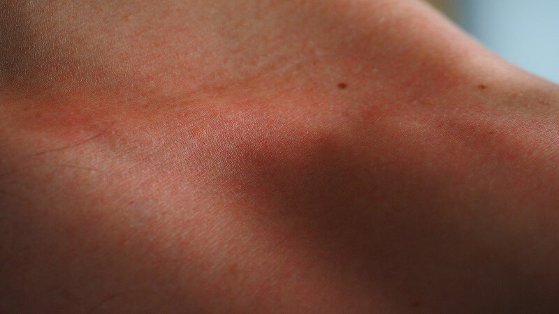 redness due to sunburn