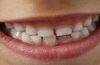 first teeth fall