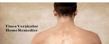 tinea versicolor diet