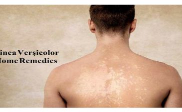 tinea versicolor diet