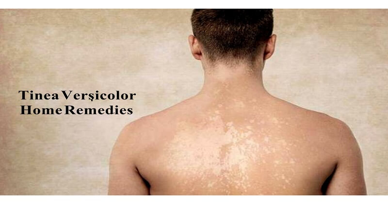 tinea versicolor diet