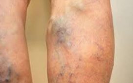 when to worry about varicose veins