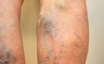 when to worry about varicose veins