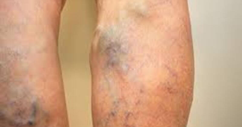 when to worry about varicose veins